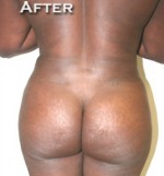 Buttock Augmentation