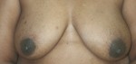 Breast Reconstruction after Mastectomy