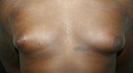Gynecomastia (Male Breast Reduction Surgery)