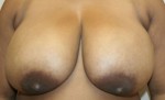 Breast Reduction (Reduction Mammaplasty)