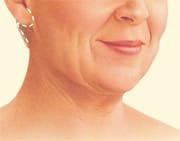 Facelift 5 Face Lift Patient Photos