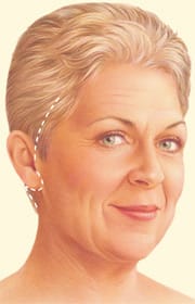 Facelift1 Facelift Procedure