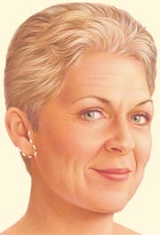 Facelift3 Face Lift Information