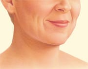 Facelift6 Facelift Patient Fort Lauderdale