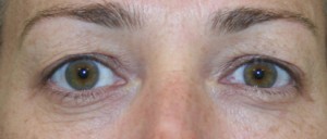 Eyelid Surgery (Blepharoplasty)