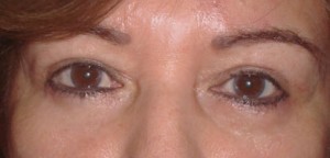 Eyelid Surgery (Blepharoplasty)
