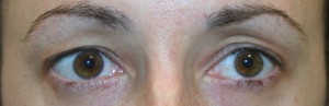 Eyelid Surgery (Blepharoplasty)